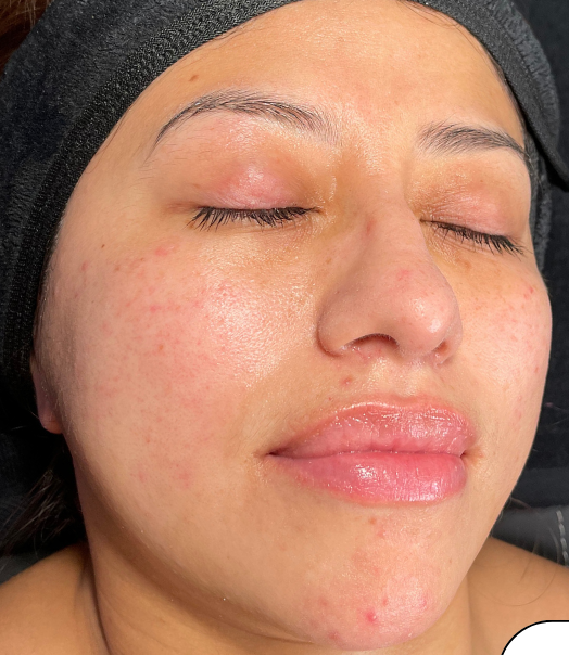 PEEL 15 AND HYDRAFACIAL RESTORE