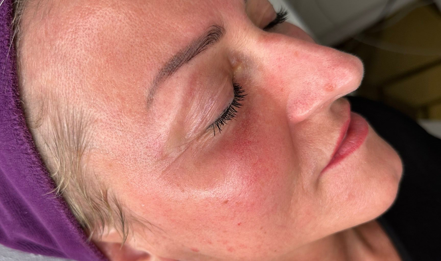 Radiance Hydrafacial After