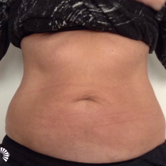 radiance coolsculpting after 4