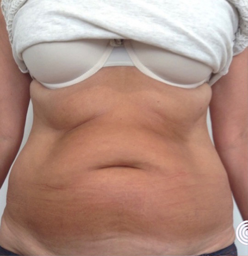 radiance coolsculpting before 4