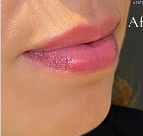 radiance dermal filler after