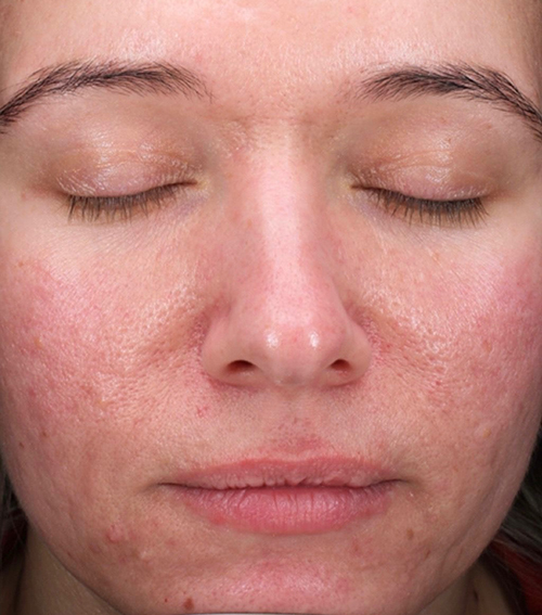 radiance microneedling after 2