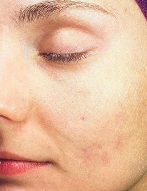 radiance microneedling after 3