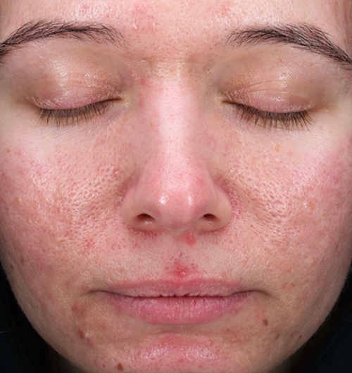 radiance microneedling before 2